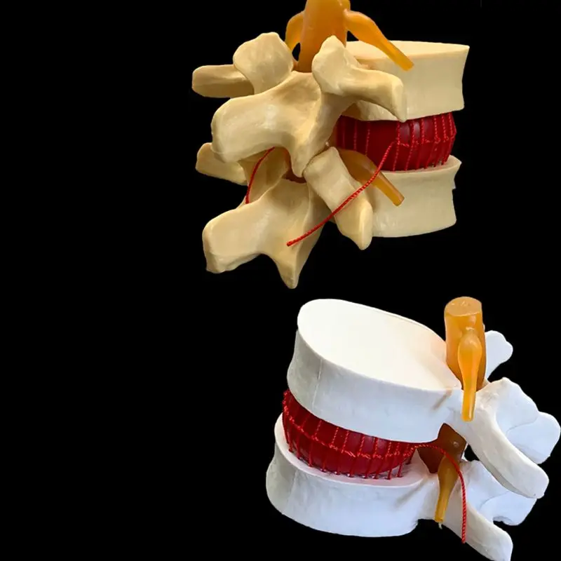 Examination Bed Medical - Anatomik İnsan Lomber Vertebra Dejeneratif Lomber